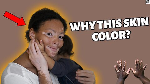 Everything you need to know on vitiligo