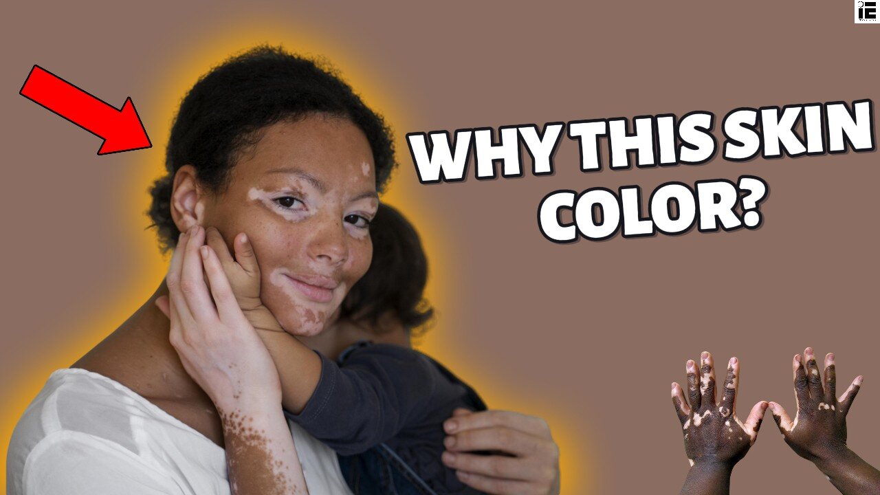 Everything you need to know on vitiligo