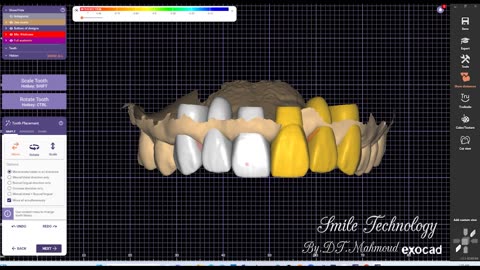 #design #naildesign #dental #dentaldesign #exocadexpert