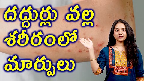 దద్దుర్లు వల్ల శరీరం లో మార్పులు Changes in the body due to Urticaria Hives or wheals | హోమియోపతి