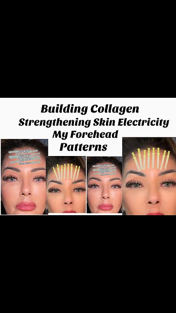 As We Age, We begin to Lose Collagen Our Skin Begins to Sag. Using PDO Threads Was My Game Changer