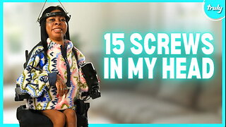 I Have 15 Screws In My Head To Straighten My Spine | BORN DIFFERENT