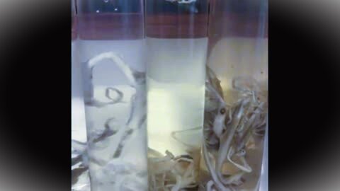 Breaking White Clot Found in Dead Covid Vaccinated Mystery Solved