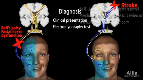 Bell's Palsy, Pathophysiology, Symptoms, Diagnosis and Treatment, Animation