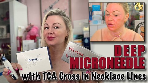Deep Microneedle with Velatox & TCA Cross for the Necklace Lines, Code Jessica10 Saves you Money