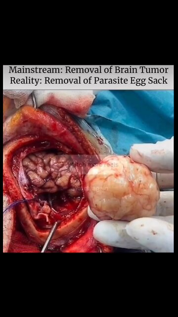 Cancer = Parasites?!?