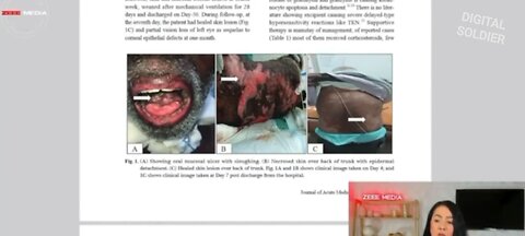 mRNA Injected People Turning Into Walking Rotting Corpses 🤯