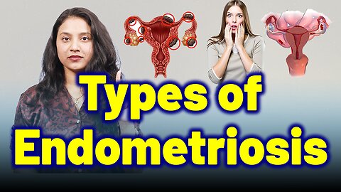 Types of Endometriosis . | Treatment Cure Medicine Surgery | Gynaecology Women Female |