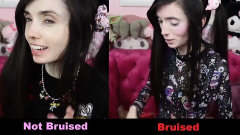 Eugenia Cooney: Bruises