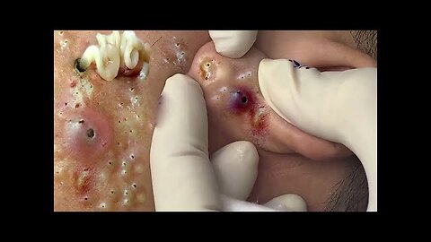 Blackheadremoval and whiteheads, dr pimplepopper cleanface