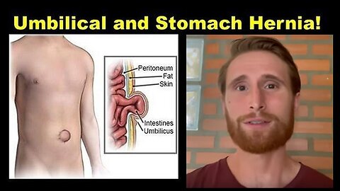 Kim Osbøl: Can you Treat Umbilical & Stomach Hernia Naturally Without Surgery? (Part 4)