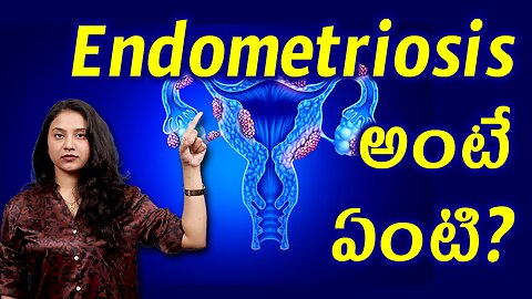 ఎండోమెట్రియోసిస్ అంటే ఏంటి? What is Endometriosis? Best Treatment Cure Medicine హోమియోపతి