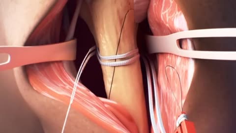 CERCLAGE SYSTEM FOR HUMERUS FRACTURE 3D ANIMATION