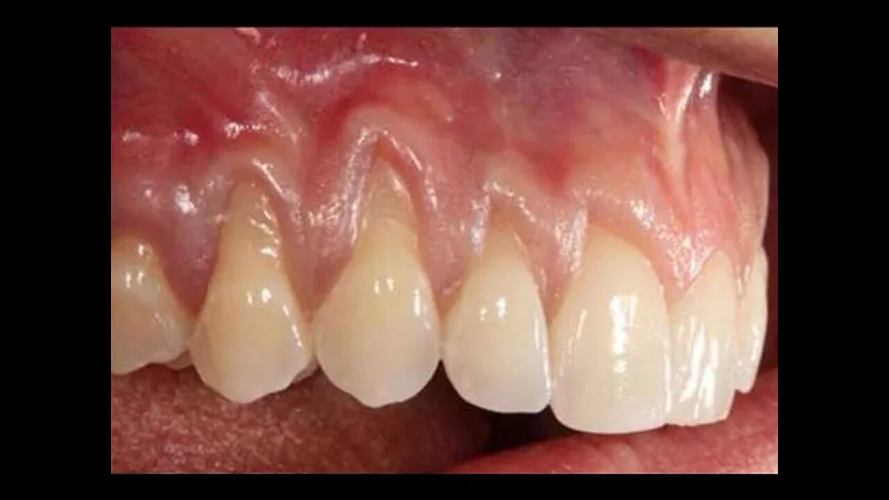 STOP Receding Gums & Whiten Teeth!