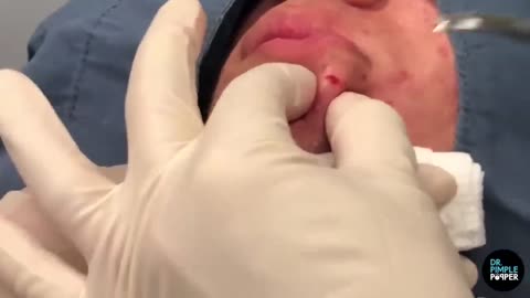 SATISFYING Dr Lee Pops Inflamed Cyst on Chin Dr Pimple Popper Reacts