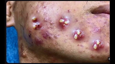 Big Cystic Acne Blackheads Extraction Blackheads & Milia, Whiteheads Removal Pimple Popping