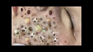 blackhead removal, relaxing Pimple Popper spa