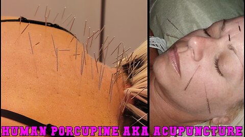 Human Porcupine AKA Acupuncture - My Story of Depression (TRIGGER WARNING)