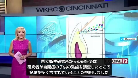 自閉症の子供の歯には有害な鉛が多く、健康に必要な亜鉛やマグネシウムが少なかった