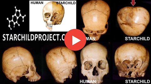 The Starchild Skull Is A Hybrid Born To A Homosapien Mother - Dr. Robinson