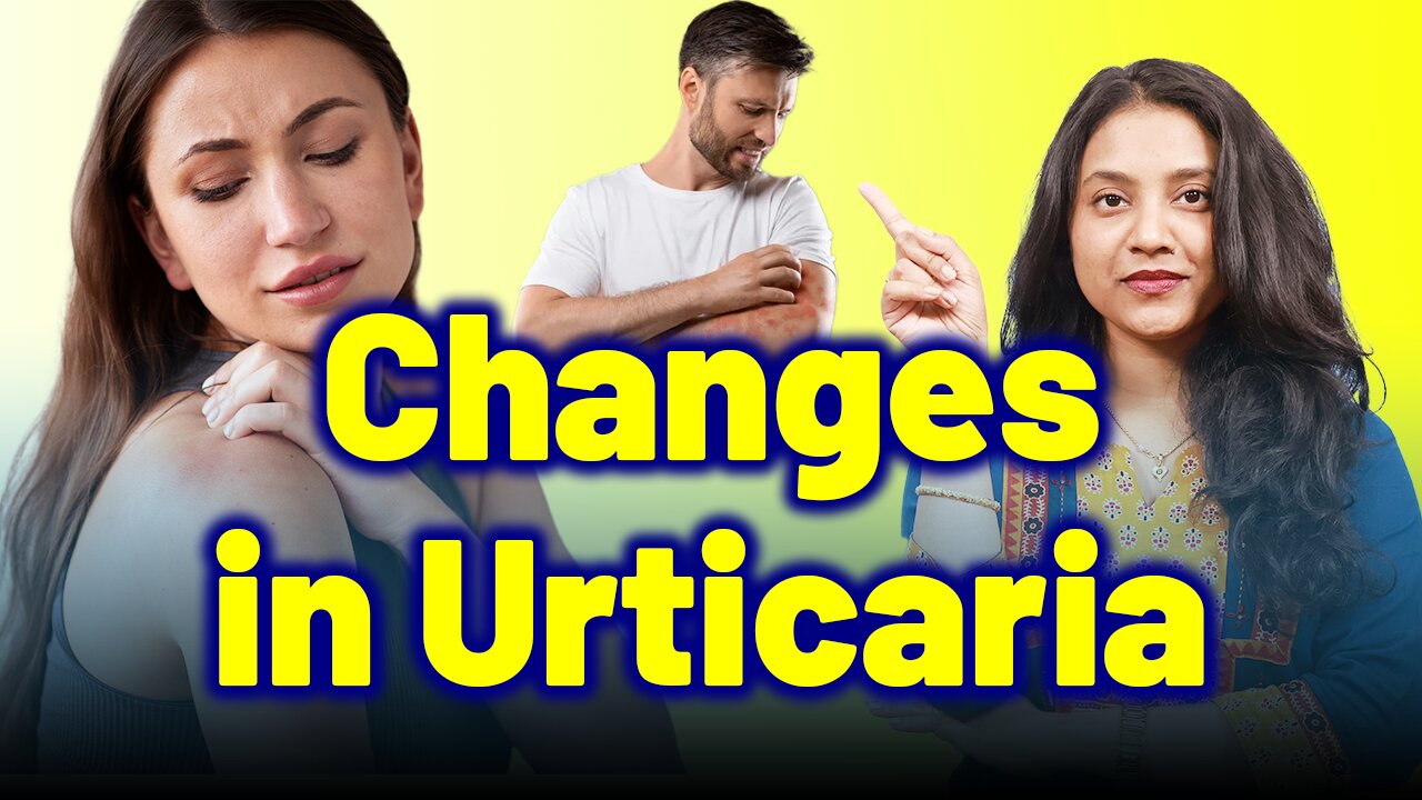 Changes in Urticaria Nettle rash, Hives, Wheals .| Skin Allergy| Treatment Cure Relief Medicine