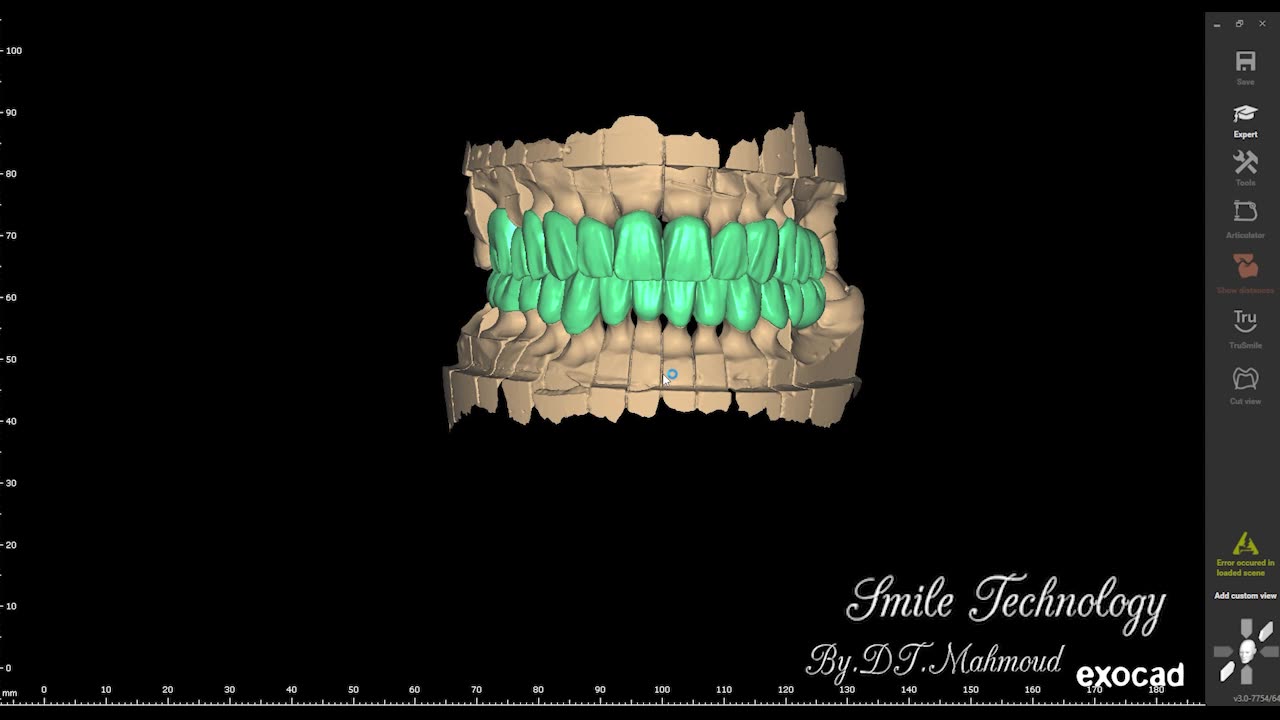 #design #naildesign #dental #dentaldesign #exocadexpert