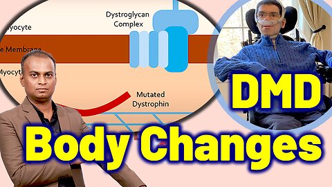 Changes in the body due to Duchenne Muscular Dystrophy DMD | Treatment Cure | Neurology Psychiatry