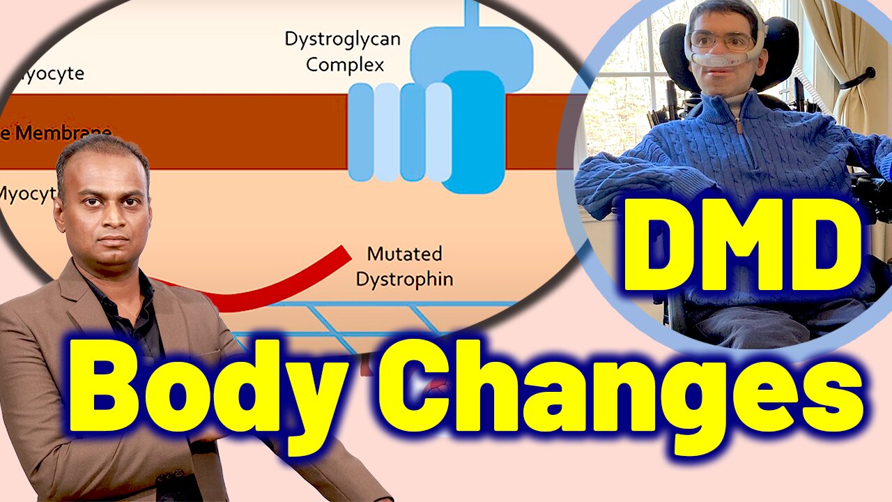 Changes in the body due to Duchenne Muscular Dystrophy DMD | Treatment Cure | Neurology Psychiatry