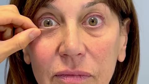 Pre-Op Evaluation: Awake Facelift, Neck Lift & Lower Eyelid Surgery | No General Anesthesia | Part 1