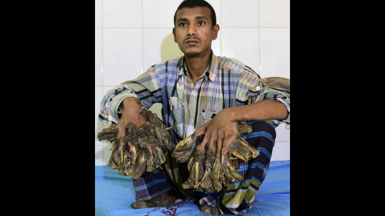 Tree Man, the strangest disease 🤢😱