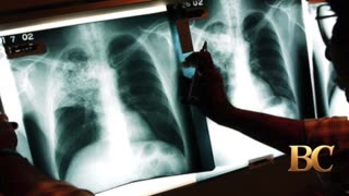 Tuberculosis outbreak that has killed 2 in Kansas continues to grow