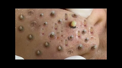 Blackheads and Whiteheads Removal PimplePopper Cystic