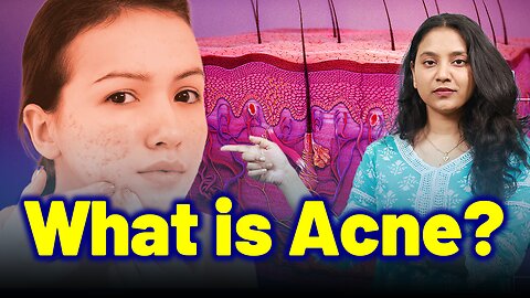 What is Acne, Pimples ,Blackheads ? | Homeopathy | Treatment Cure Relief Medicine