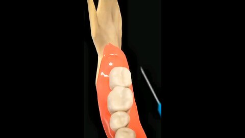 why people remove wisdom teeth