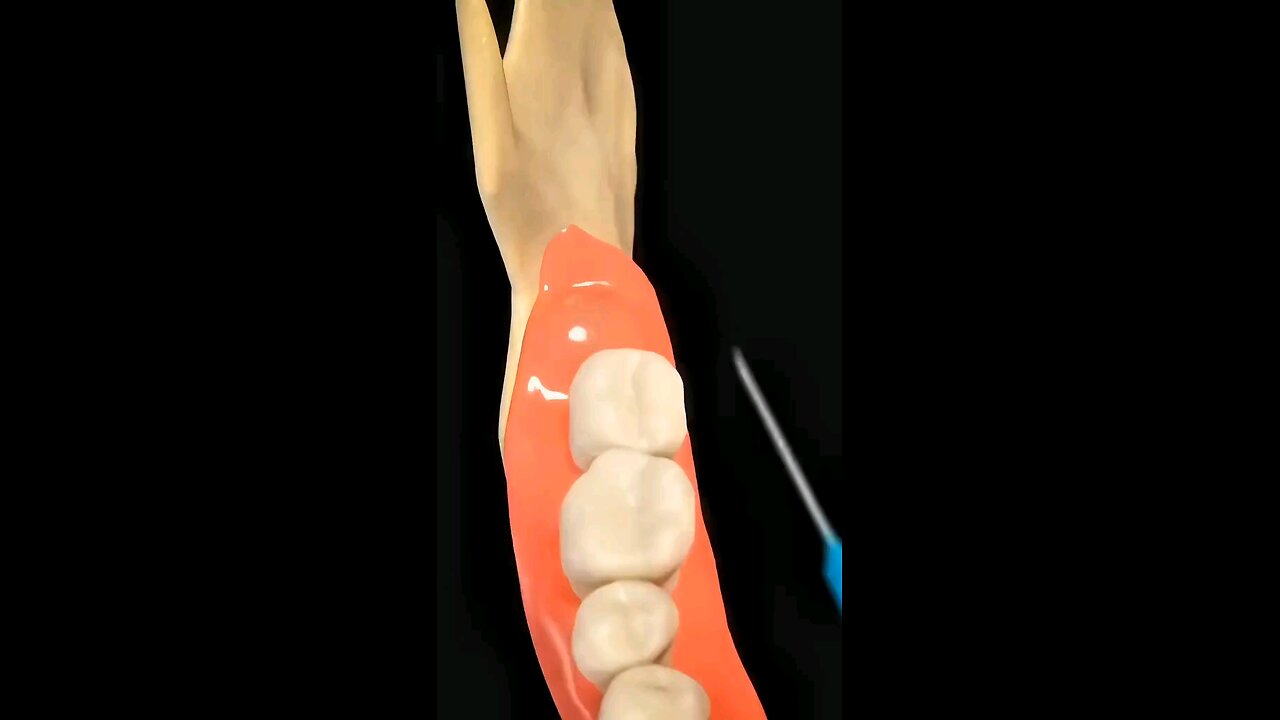 why people remove wisdom teeth