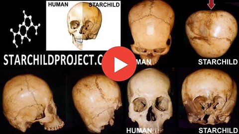 THE STARCHILD SKULL IS A HYBRID BORN TO A HOMOSAPIEN MOTHER - DR. ROBINSON