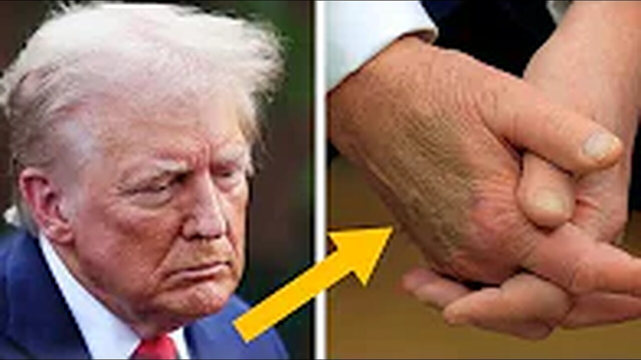 Trump's BRUISED HANDS trigger health panic
