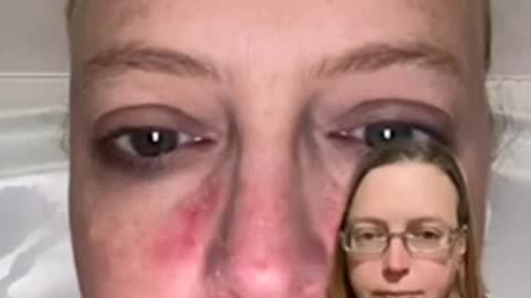 Ivermectin Immediatley Cures Her of Cronic Rosacea After 12 Years