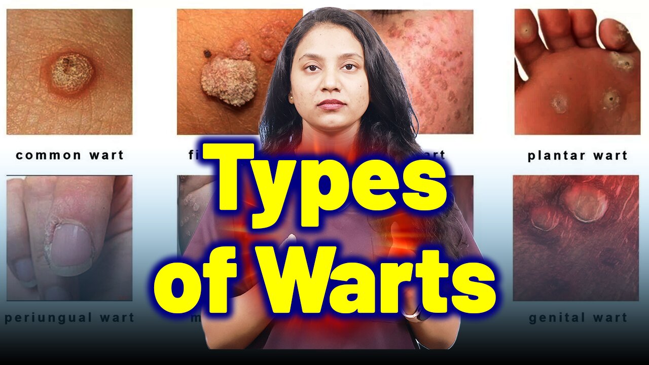 Types of Warts | Treatment Cure Relief Medicine | Skin Hair Nail | Homeopathy