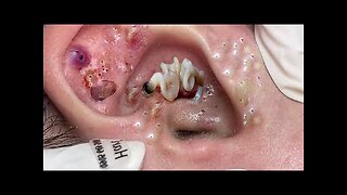 Satisfying blackhead Whiteheads removal relaxing PimplePopper Extraction #7890