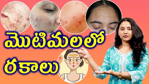 మొటిమలలో రకాలు | Different Types of ACNE or Pimples Blackheads Treatment Cure | హోమియోపతి