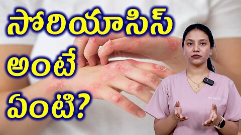 సోరియాసిస్ అంటే ఏమిటి ? What is Psoriasis ? Homeopathy Tereatment Cure Medicine | హోమియోపతి