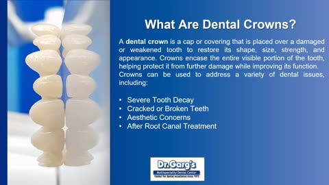 What Are Dental Crowns?