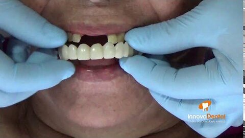 Snap On Smile prosthesis removable | PSN Experiment