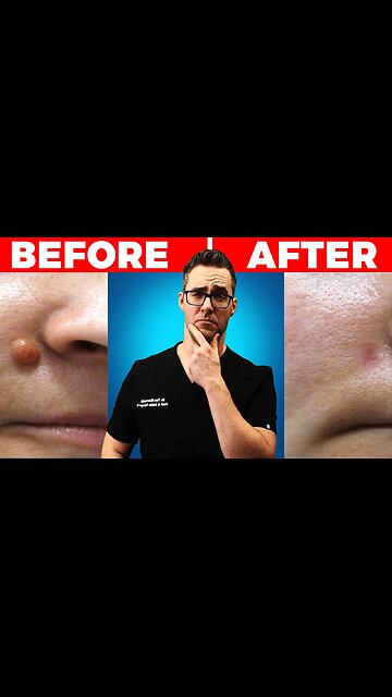 Skin Tags & Plantar Warts DISAPPEAR Overnight? [Best Home Remedies]