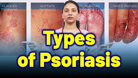 Types in Psoriasis | Treatment Cure Relief Medicine | Skin Hair Nail | Homeopathy