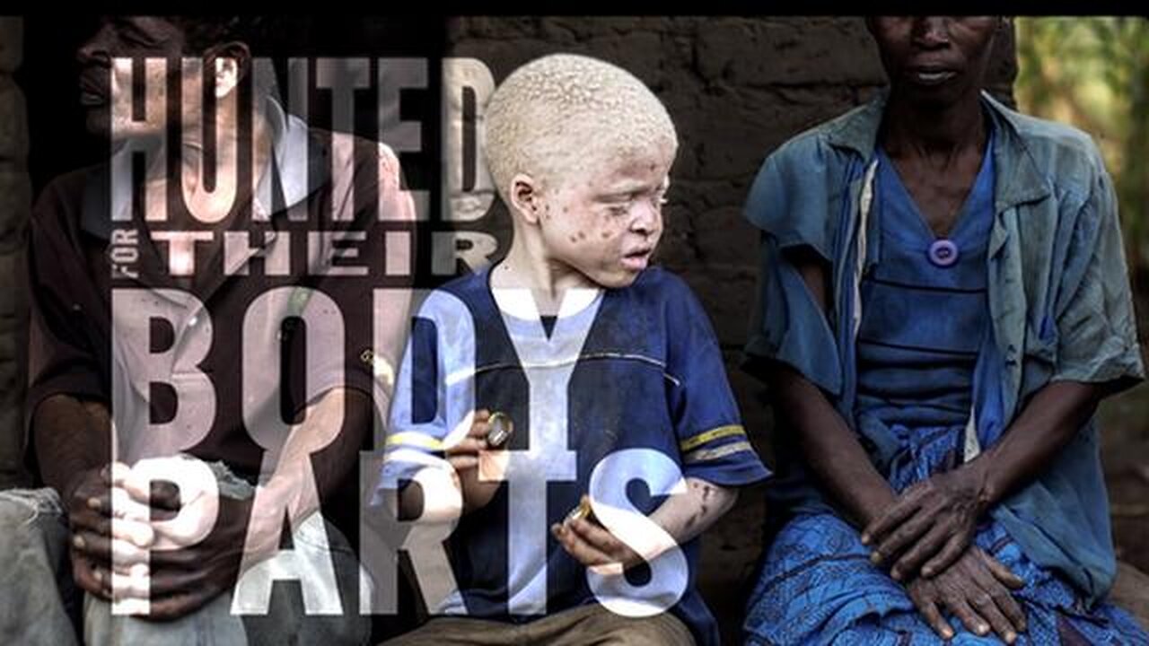 African Albinos Hunted For Their Body Parts