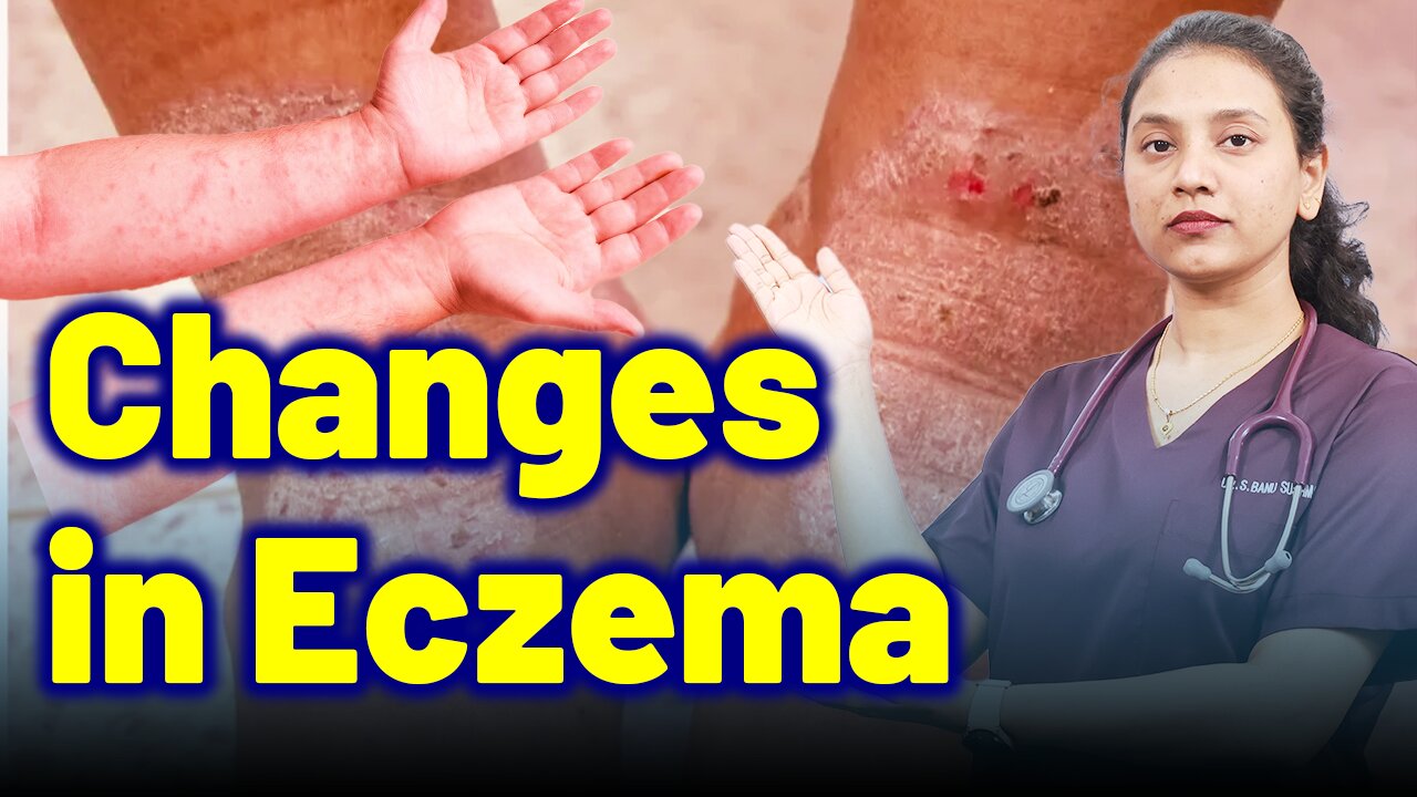 Body Changes in Ecezma | Treatment and Cure | Homeopathy, Medicine & Surgery