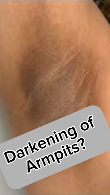 Darkened armpits?
