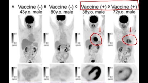 In 100% of covid19 vaccinated persons (700 investigated) was observed inflammatory process in hearts